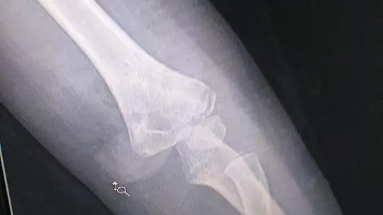 Minik İdil ölümden döndü 