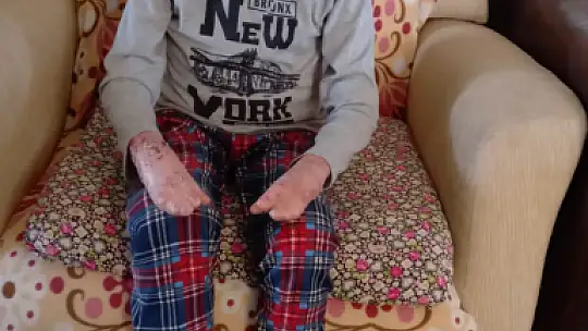 12 Yaşındaki Kelebek Hastası Metecan Yardım Bekliyor